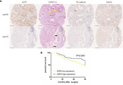 The Angiotensin-Converting Enzyme Inhibitory State Promotes the Transformation of Non-Small Cell Lung Cancer Blood Supply Pattern Toward Vasculogenic Mimicry Formation